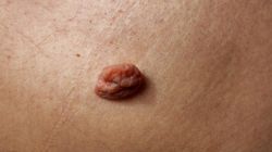 Verrumal - zastosowanie, przeciwwskazania, skutki uboczne, skuteczność i cena