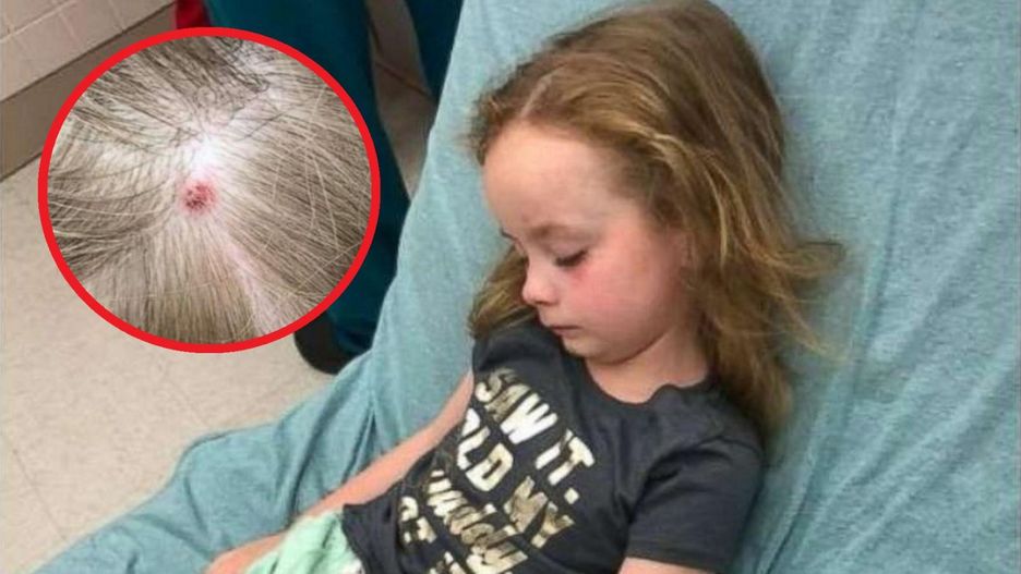 5-latkę nagle dopadł paraliż. Wszystko się wyjaśniło, gdy to odkryli na głowie