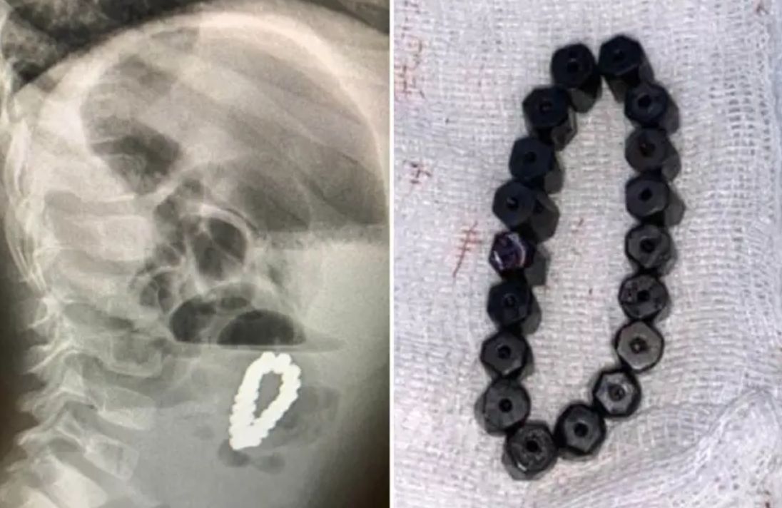 Czterolatek połknął bransoletkę