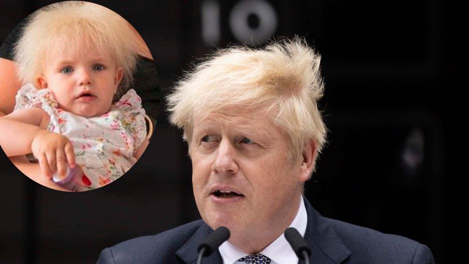 Dziewczynka cierpi na Syndrom Nieuczesanych Włosów