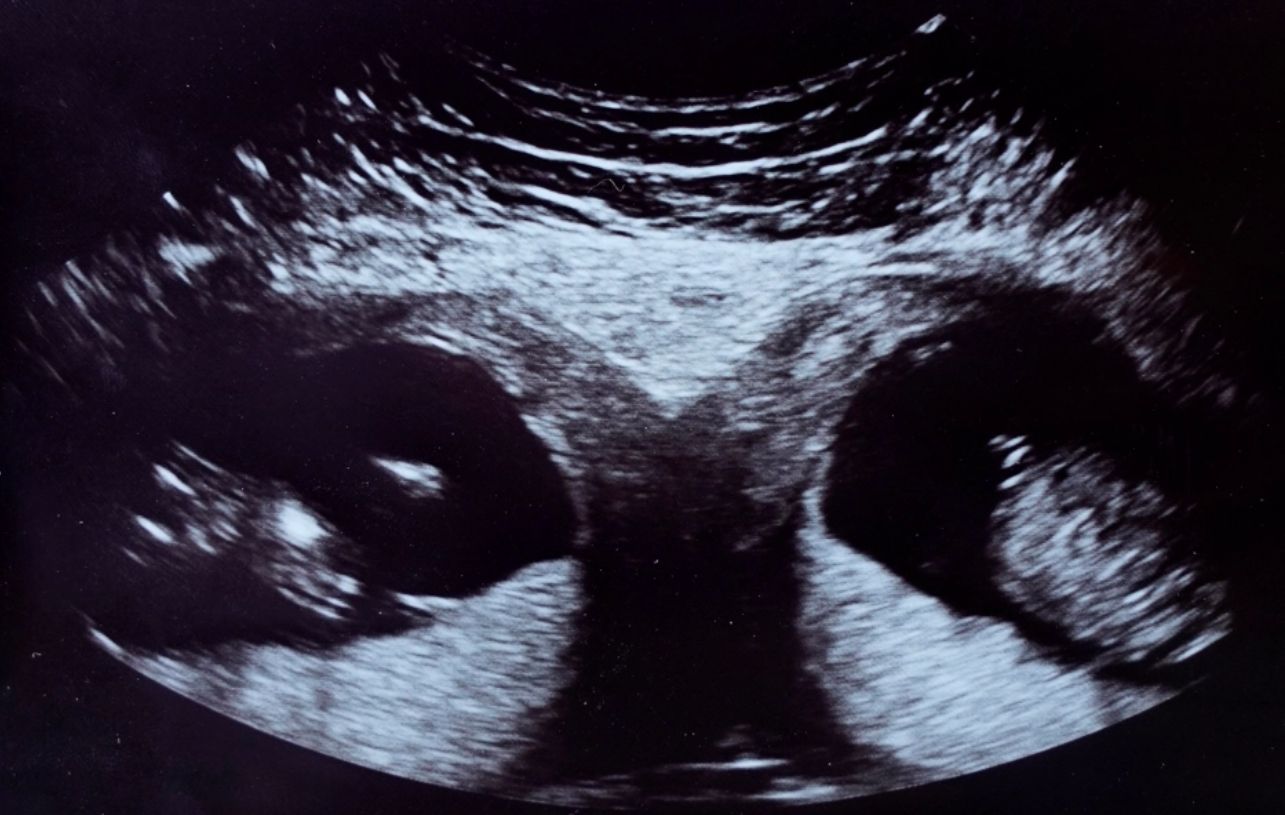 Zdjęcie USG, które pokazało nietypowe zmiany w organizmie Kelly (Facebook)