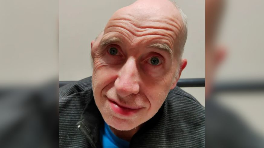 Cierpiał na "paskudną migrenę". Musieli usunąć mu jedną trzecią czaszki