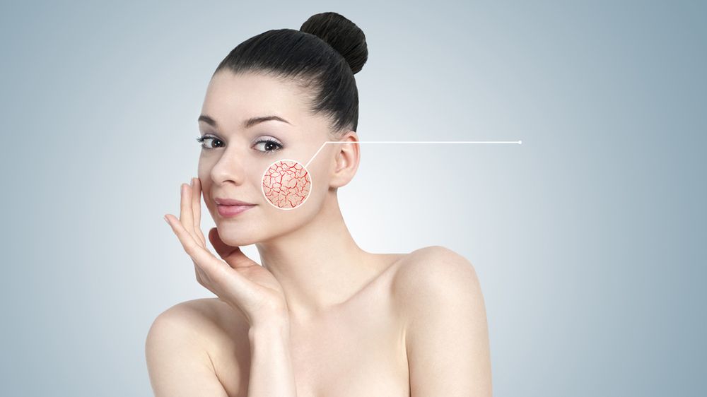 Popękane naczynka na nosie – przyczyny problemu i leczenie