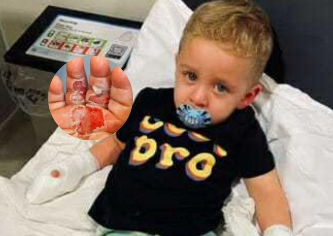 Odkurzacz wessał rękę dziecka. Chłopiec doznał oparzeń i wstrząsu toksycznego