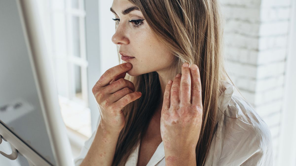 Liszaj – objawy, leczenie, profilaktyka