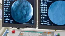 Angiografia - na czym polega, wskazania, przeciwwskazania, powikłania