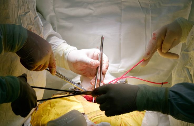 Wszczepienie bajpasów polega na przywróceniu przepływu krwi z aorty do zaatakowanych przez blaszki miażdżycowe tętnic wieńcowych.