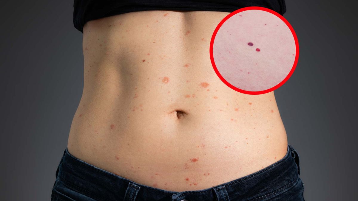 Wysyp czerwonych kropek na ciele? Tak organizm może ostrzegać cię o chorobie