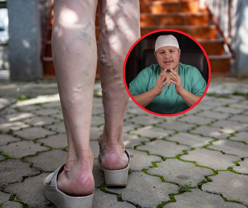 Lekarz zdradza pięć objawów objawów zakrzepicy. Pojawiają się u 50 proc. pacjentów