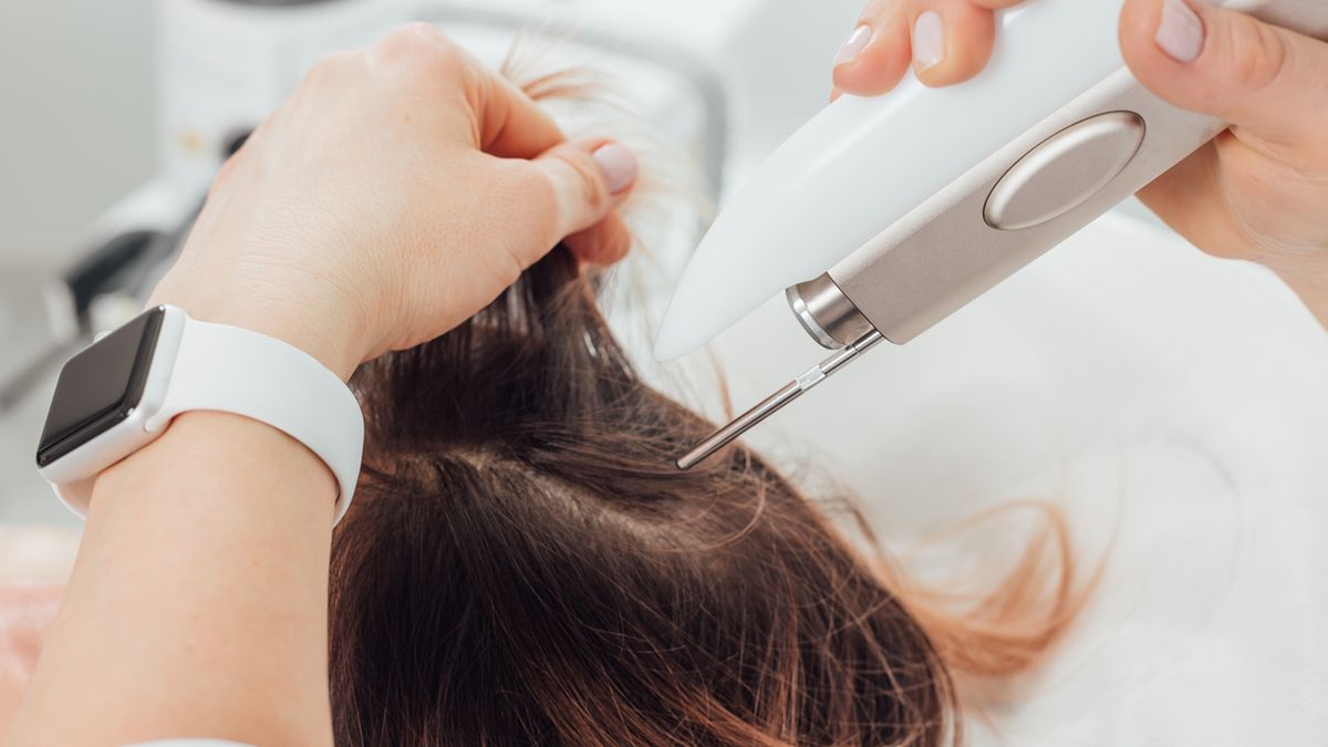 Laser frakcyjny a łysienie plackowate to zagdanienie, które może zainteresować osoby zmagające się z utratą włosów