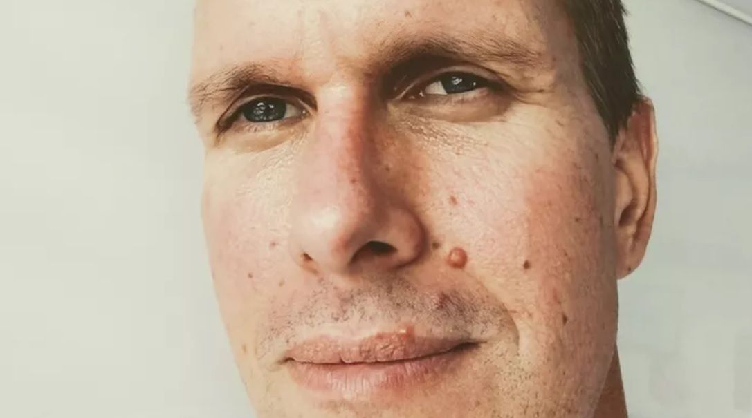 Geoffrey Seymour walczy z rakiem jelita grubego