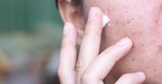 Krem na trądzik – który dobry, a jaki nieodpowiedni?