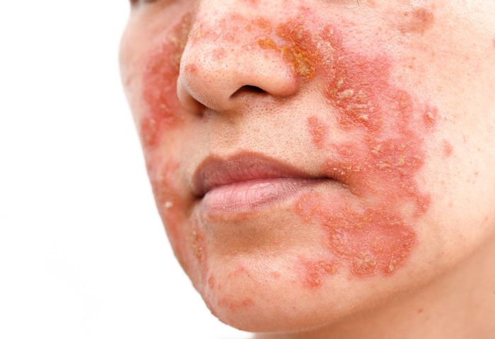 Łojotokowe zapalenie skóry to przewlekła, nawracająca choroba. Cechuje się łuszczącą skórą na twarzy, we włosach i innych miejscach ciała.