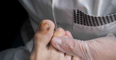 Czerniak paznokcia - przyczyny, objawy, diagnostyka, leczenie