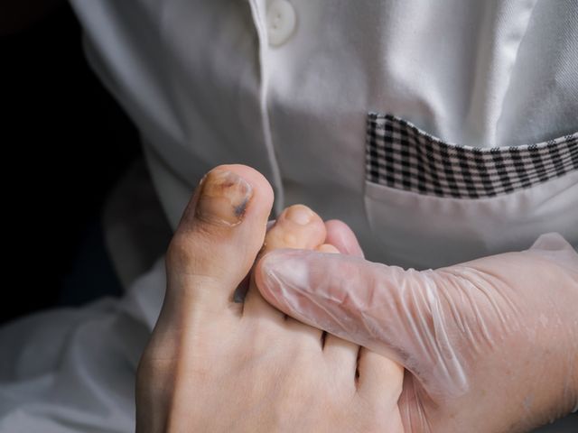 Czerniak paznokcia to odmiana nowotworu złośliwego, rozpoznawana co roku u 2 500 osób.