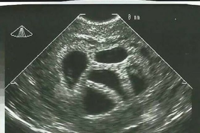 Badanie USG pokazujące pięć zarodków