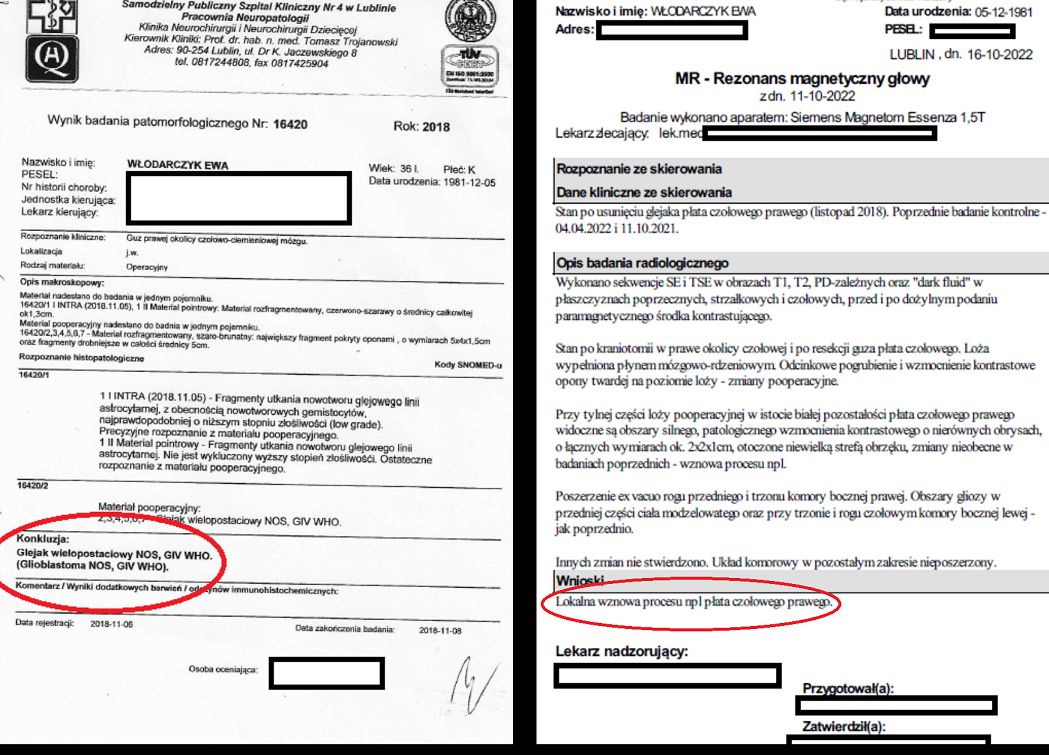 Rezonans magnetyczny ujawnił glejaka w mózgu