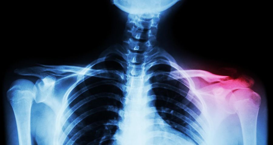 Zwichniecie stawu barkowo-obojczykowego powstaje najczęściej w wyniku upadku na ramię i rozerwania więzadeł w obrębie obwodowej części obojczyka