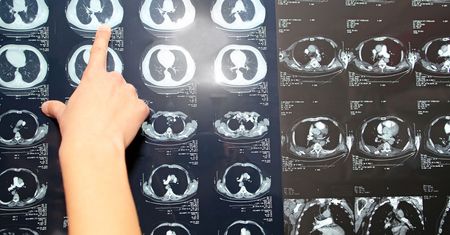 Kardiolog: W zatorowości płucnej każda sekunda jest cenna