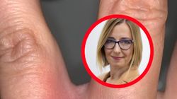 Jak zachować się po ugryzieniu przez kleszcza? Lekarka ma rady