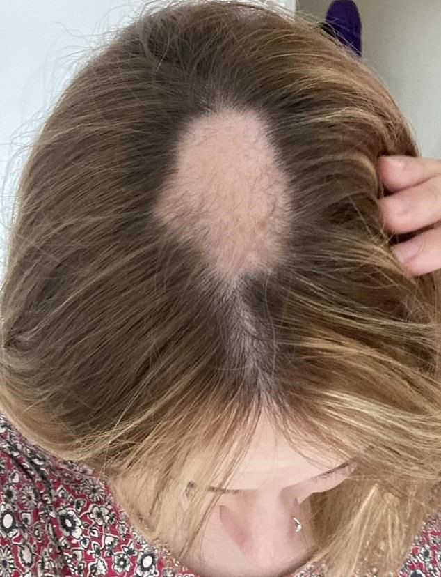 Łysina wielkości pięści