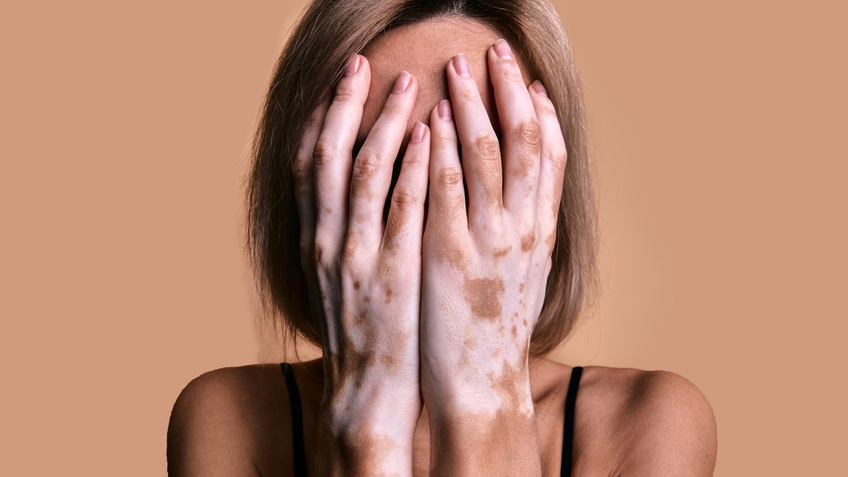 Hipopigmentacja może mieć charakter wrodzony lub nabyty.