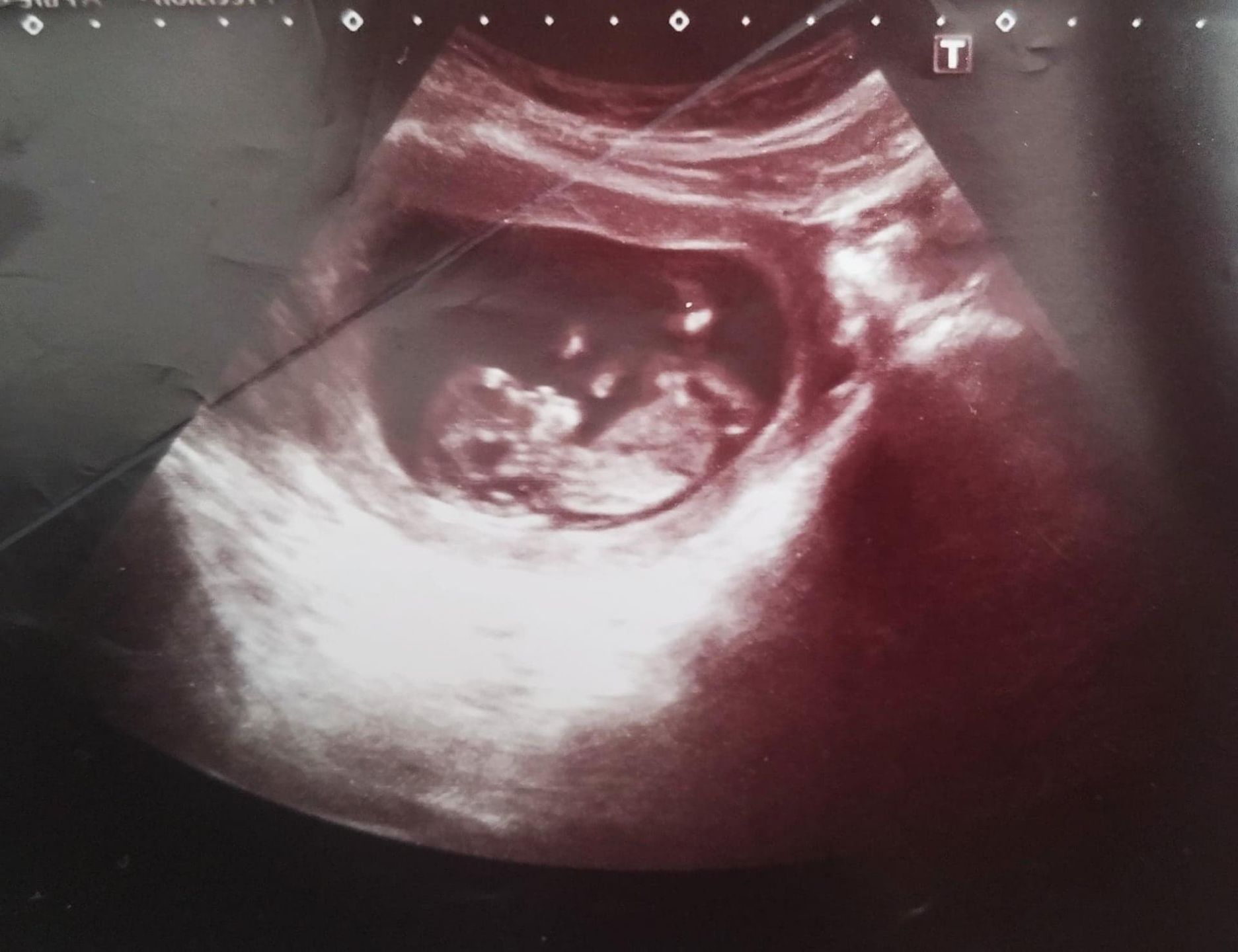 U płodu stwierdzono szereg wad