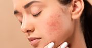 Ziarniniak kwasochłonny twarzy – przyczyny, objawy i leczenie