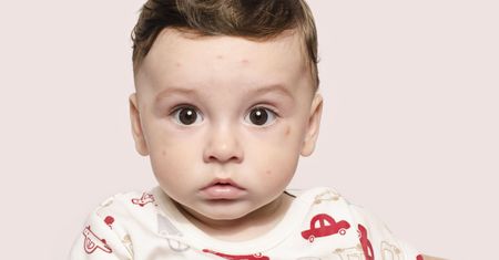 Różyczka - objawy, różyczka u dzieci i dorosłych, przebieg, diagnozowanie, zagrożenie dla kobiet w ciąży