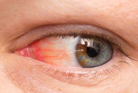 Czerwone oko – przyczyny, leczenie