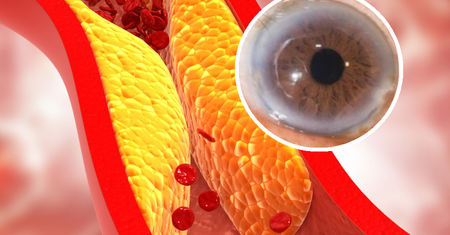Zauważysz natychmiast. Znak, że cholesterol zapycha tętnice
