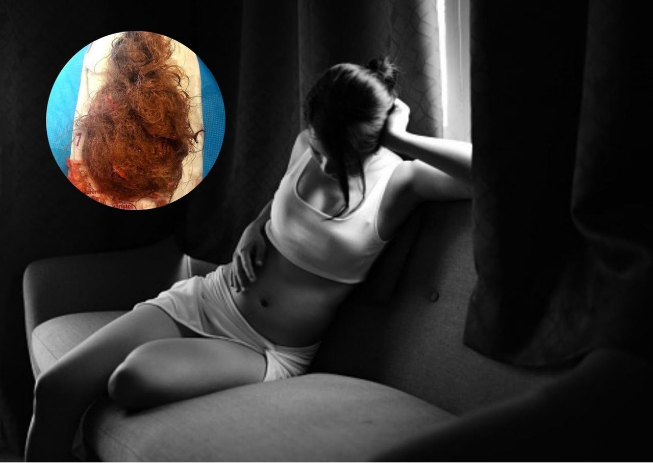 Ginekolog pokazał, jak wygląda guz jajnika. "Zawiera w pełni ukształtowane włosy, a niekiedy także zdeformowane zęby"