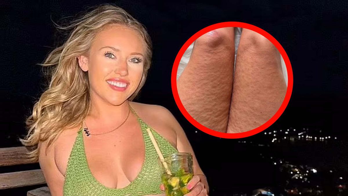 Na wymarzonych wakacjach złapała dengę. Tak objawiała się choroba