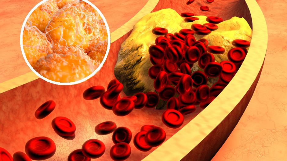 Badacze z Duke Cancer Institute w Stanach Zjednoczonych odkryli, że podwyższony poziom cholesterolu może nie tylko sprzyjać powstawaniu raka