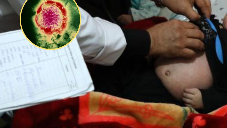 Grozi nam epidemia odry? WHO bije na alarm