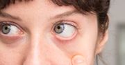 Zatkane kanały łzowe u dorosłych – domowe sposoby i leczenie