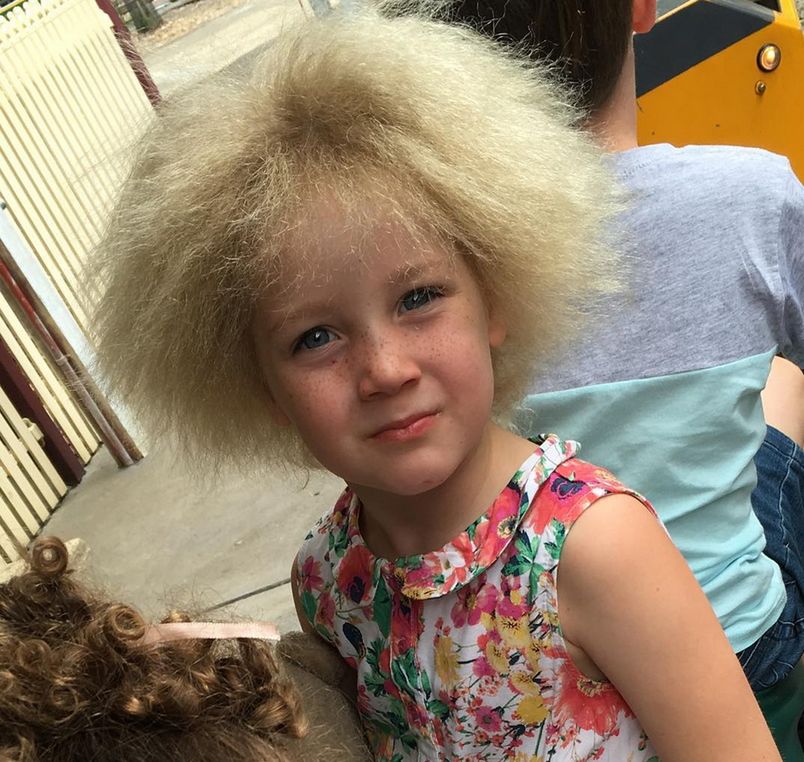 Shilah doknięta syndromem nieuczesanych włosów