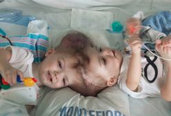 Skomplikowana operacja rozdzielenia bliźniąt syjamskich zakończona sukcesem. Tak wyglądają chłopcy po rozdzieleniu