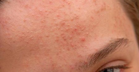 Przewlekły stres i lęk mogą wywołać objawy dermatologiczne. Jakie schorzenia skóry mają podłoże psychiczne?