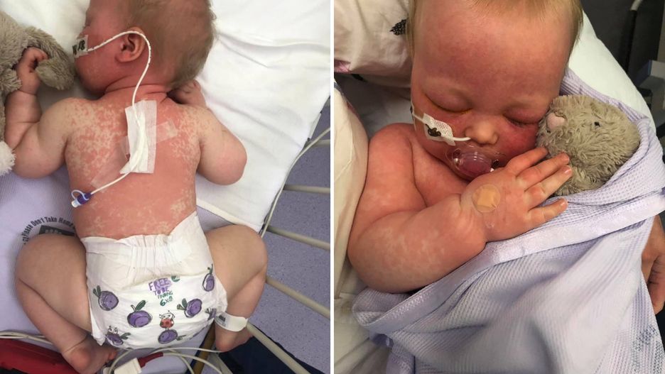 Pokazała jak wygląda dziecko chore na odrę. Apeluje żeby szczepić dzieci