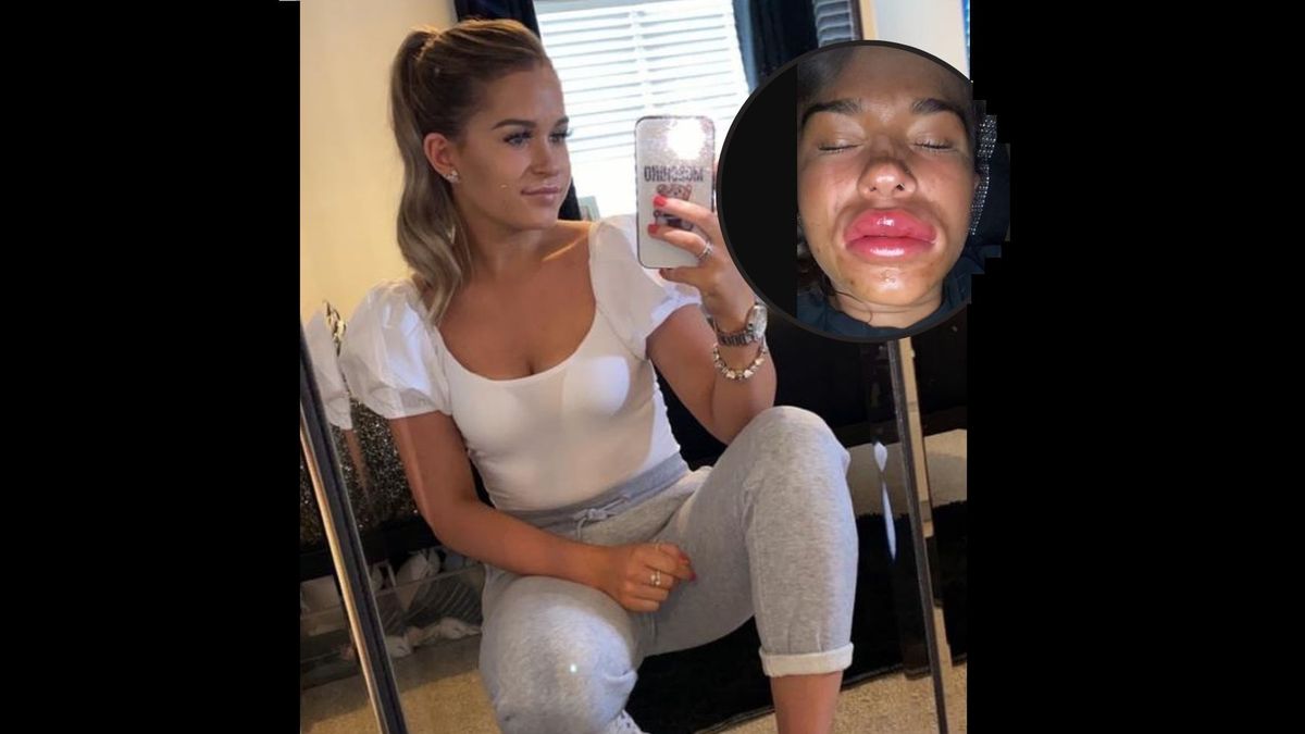 Brytyjka ostrzega przed piciem alkoholu po zabiegach powiększania ust. Sama przeszła przez koszmar