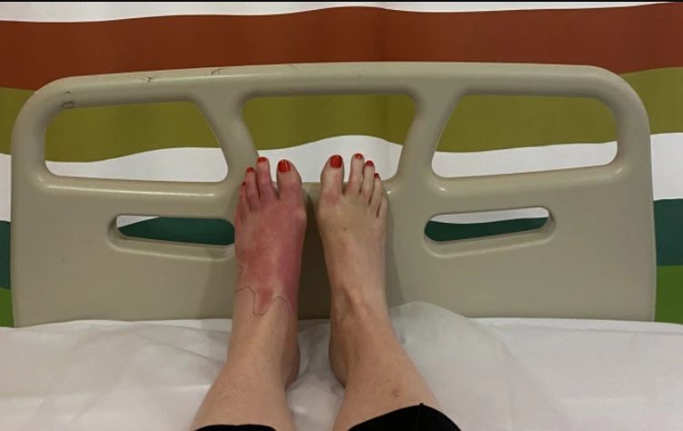 Na nodze wystąpiły zaczerwienienie, opuchlizna i plamy