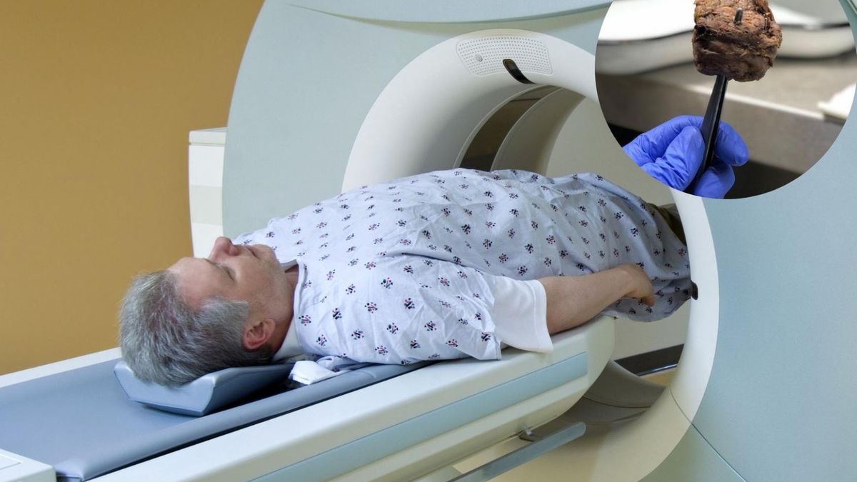 Nowotwór prostaty długo nie daje objawów