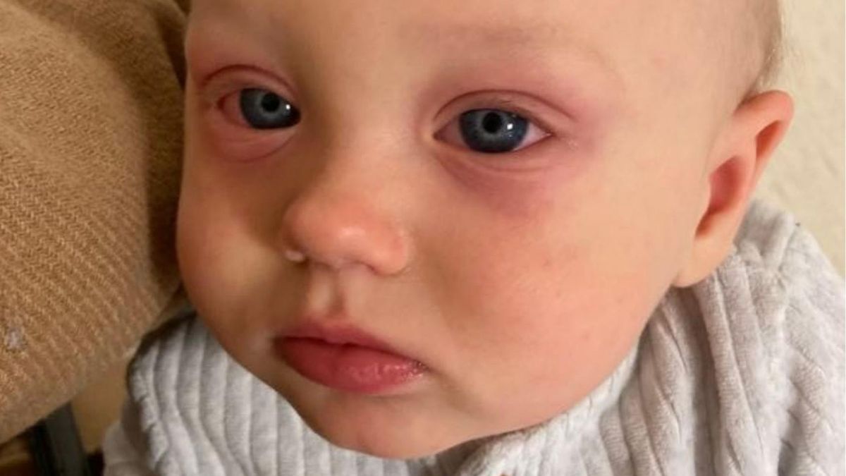 Jednym z objawów PIMS u Jasia były zaczerwienione oczy. Dopiero czwarty lekarz postawił prawidłową diagnozę