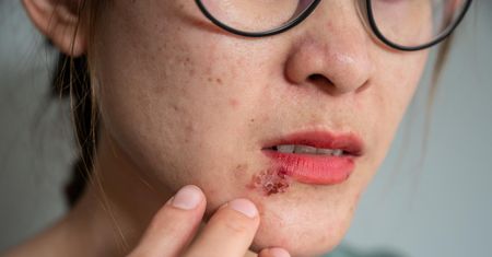 Codziennie stosowała krem nawilżający z filtrem SPF. Diagnoza zwaliła ją z nóg