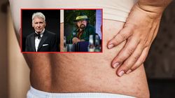 Harrison Ford i Zbigniew Hołdys mają półpaśca. Objawy są "bardzo charakterystyczne"
