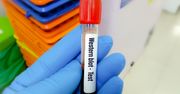 Test Western Blot – wskazania, przygotowanie, przebieg, cena