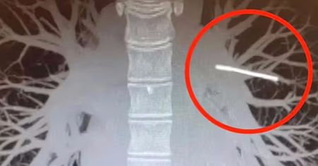 Implant antykoncepcyjny przemieścił się z ramienia kobiety. Lekarze znaleźli go w nieoczekiwanym miejscu