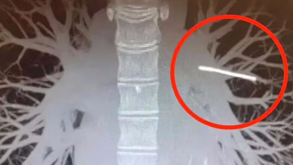 Implant antykoncepcyjny matki przemieścił się z ramienia. Lekarze znaleźli go w nieoczekiwanym miejscu