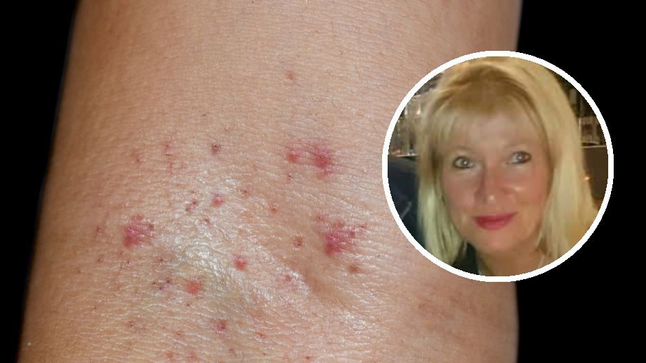 Męczą cię nawracające infekcje i łatwo o siniaki? Tak może objawiać się nowotwór krwi